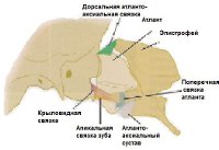 Заболевание позвоночника - атлантоаксиальная нестабильность (ААН)