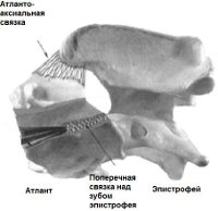 Заболевание позвоночника - атлантоаксиальная связка (норма)
