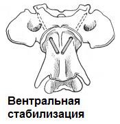 вентральная (с помощью спиц Киршнера) фиксация