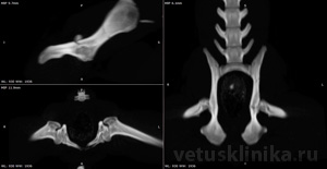 3D CT scan перелом левой вертлужной впадины